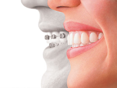 An illustration showing a smiling woman with an overlay of a mouthpiece and an image of a smiling man s teeth.