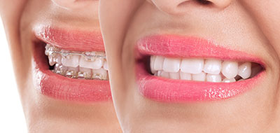 The image is a composite of two photographs, one showing a person s face with a smile and the other displaying a close-up of teeth.