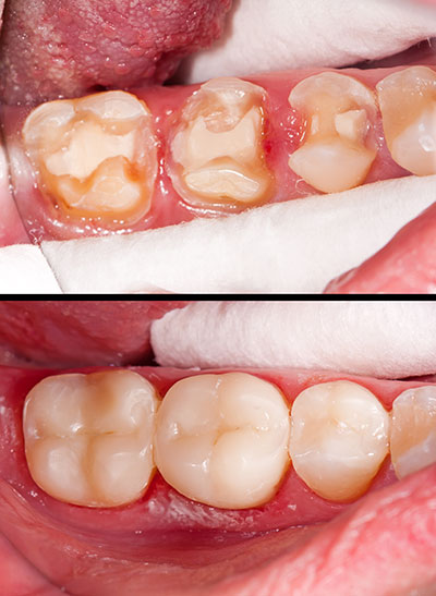 Before and after image of a dental procedure, showcasing teeth with decay and staining in the upper left corner, compared to clean, restored teeth in the lower right corner.