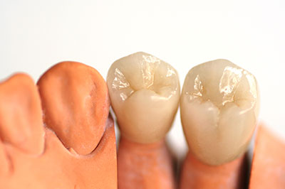 An image showcasing a set of artificial teeth and gums, possibly for dental implants or prosthetics.