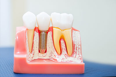 The image shows a model of a human mouth with artificial teeth and gums, displaying various dental implants or prosthetics, including a visible screw.