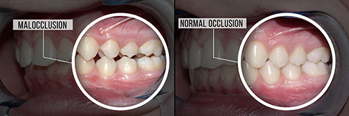 The image shows a side-by-side comparison of a mouth with teeth and gums, before and after what appears to be a dental procedure or treatment, highlighting the transformation from a natural state to an altered condition.