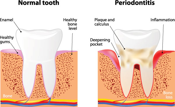 The image is a four-panel educational graphic illustrating the process of tooth decay, from normal to advanced stages, with annotations explaining the progression.