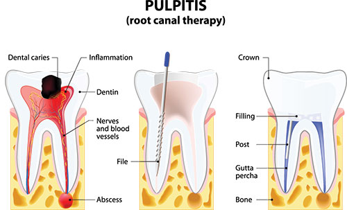 The image is an educational illustration explaining the structure and process of pulpitis, a dental condition involving inflammation within the tooth s pulp chamber.