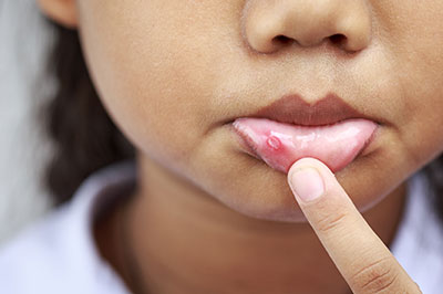 A young girl with a pimple on her chin is pointing at it with her finger.