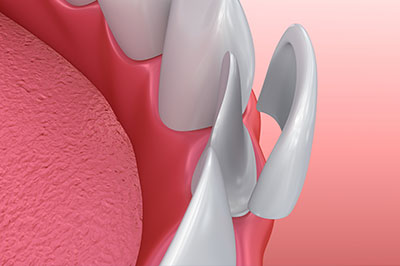 An illustration of a dental implant with a focus on the surgical attachment, set against a pink background.