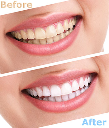 The image shows a side-by-side comparison of a person s teeth before and after teeth whitening treatment, with the  after  showing brighter, cleaner teeth.