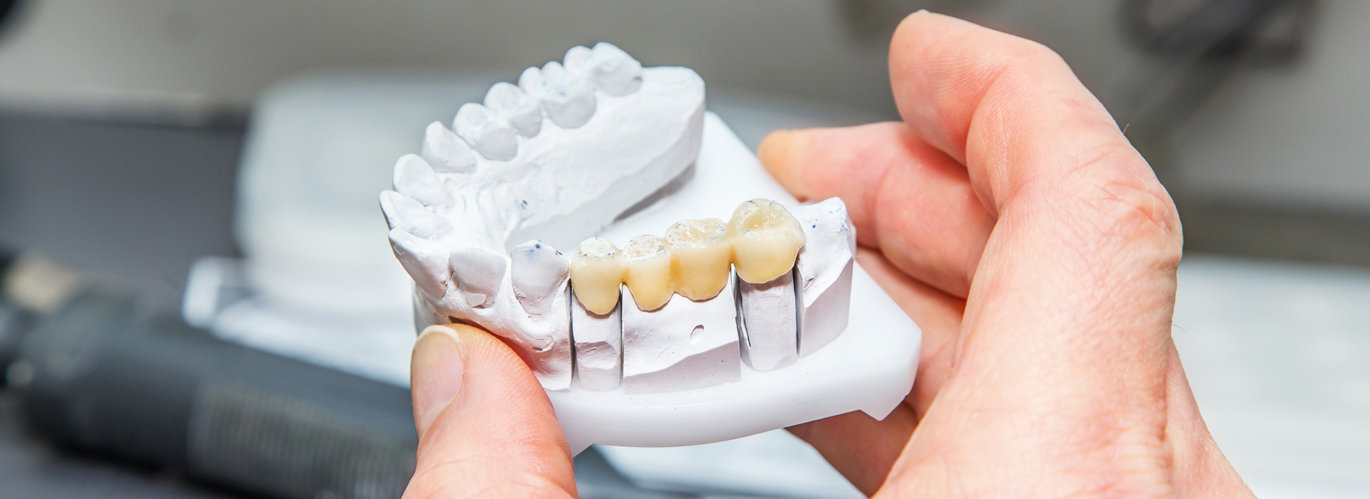 An individual holding a 3D printed dental implant model.