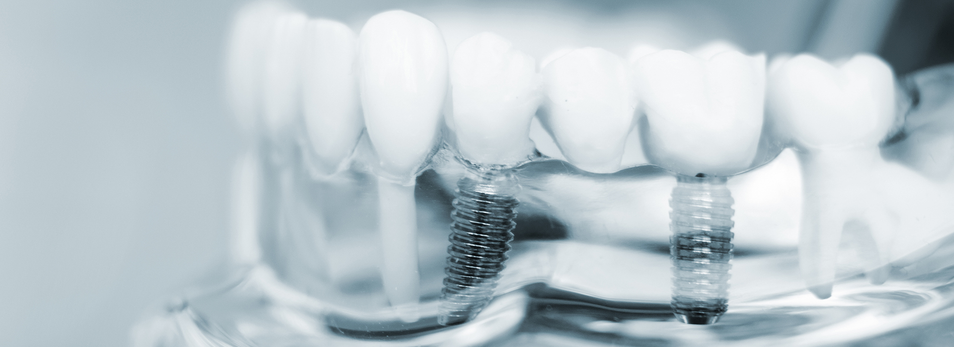 Dental implant with screw and abutment, set against a blurred background.