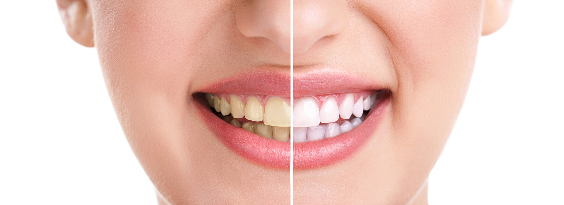 An image of a person s face showing the result of teeth whitening, with a before and after comparison.