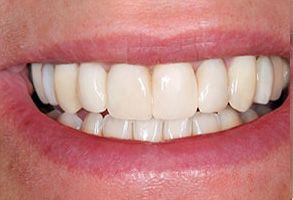 The image shows a person smiling with a bright, white smile and teeth, which is likely for dental or cosmetic purposes.