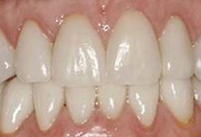 The image shows a close-up of a person s teeth, revealing a smile with dental implants, and the teeth appear to be well-maintained.