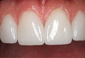 Teeth with a close-up view, showcasing a cosmetic dental treatment.