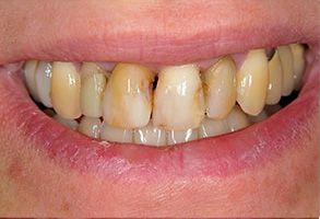 The image displays a close-up of a person s mouth with a yellowish discoloration on the teeth, which suggests possible dental issues such as staining or decay.